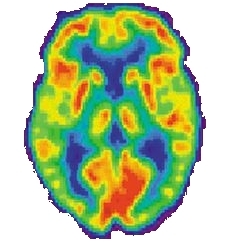 Image of a Positron Emission Tomography (PET) scanned brain.